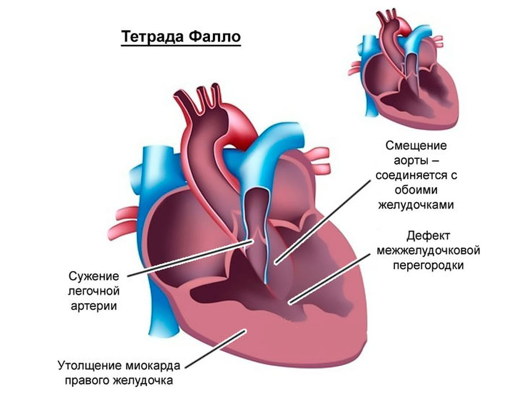 Тетрада фалло картинки