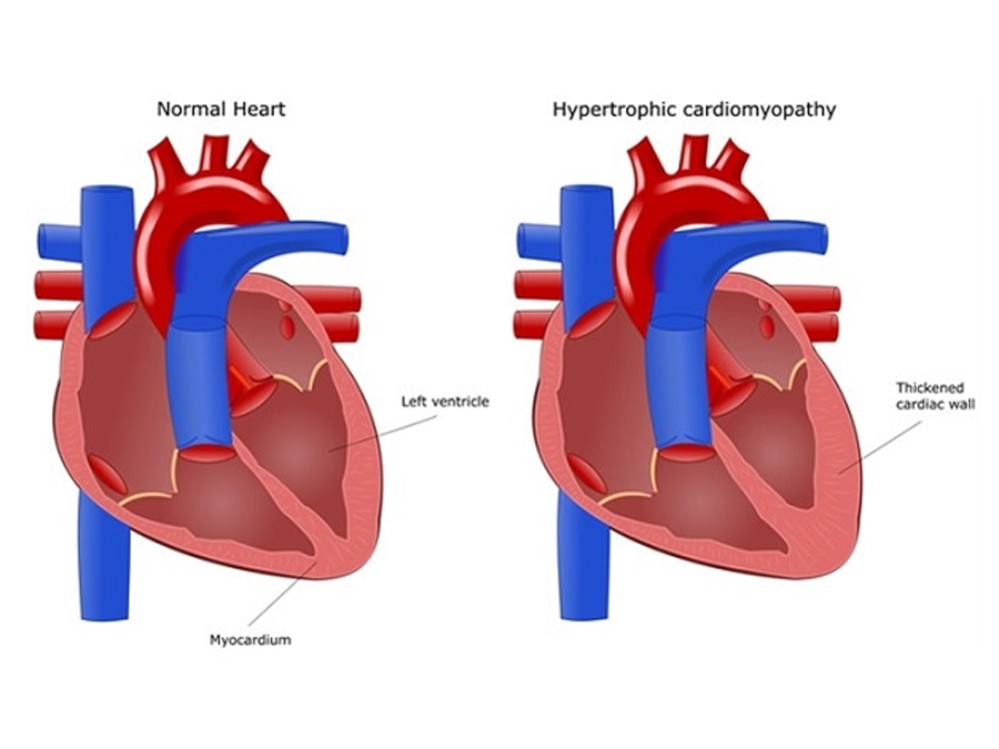 Клинико-инструментальная характеристика идиопатических гипертрофических кардиомиопатий