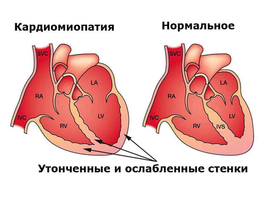 Высокогорная кардиомиопатия