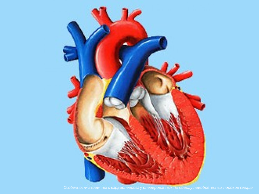 Особенности вторичного кардионевроза у оперированных по поводу приобретенных пороков сердца