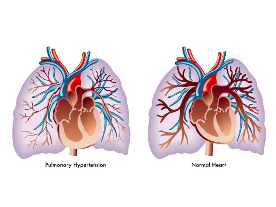 Количественные аспекты изучения пато- и морфогенеза легочного сердца после резекций легких
