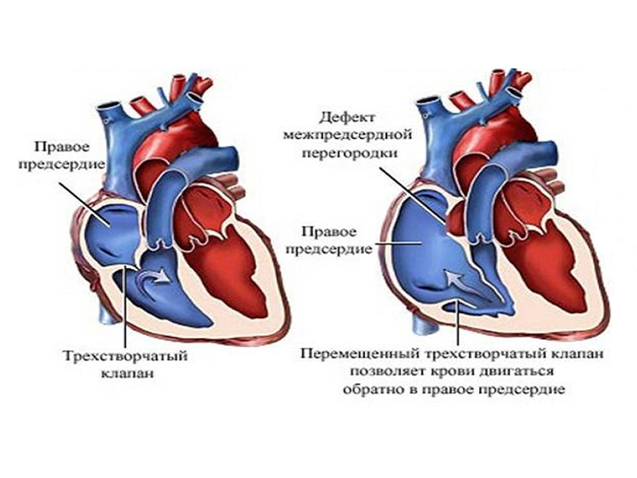 Врожденные пороки сердца (ВПС) - симптомы, лечение, …